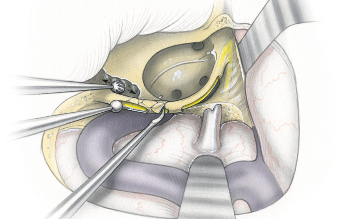 Transcochlear approach – Skull Base Surgery Atlas