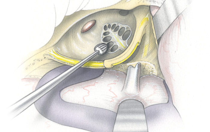 Transcochlear approach – Skull Base Surgery Atlas