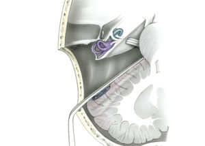 The retrolabyrinthine approach is an anterosigmoid posterior craniotomy which preserves the structures of the inner ear. To obtain posterior fossa exposure, bone much be removed a considerable distance behind the sigmoid sinus and the semicircular canals are skeletonized.
