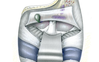 In the retrolabyrinthine approach the dural flap is designed to preserve the endolymphatic sac and its aqueduct. While this opening, by itself, provides only limited posterior fossa exposure, when combined with a middle fossa craniotomy and division of the tentorium considerably wider exposure than that depicted here can be obtained. (ES, endolymphatic sac; 7, facial nerve; 8, audiovestibular nerve; P, Posterior semicircular canal; L, lateral semicircular canal.)