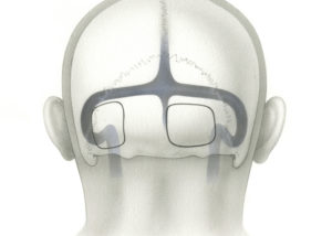 In the classical suboccipital approach bone is removed from the midline laterally until the first air cells are encountered. This often creates an opening located well posterior to the sigmoid sinus. When a suboccipital approach is used to expose the CPA, a relatively large amount of cerebellar retraction is necessary. With the retrosigmoid approach, where the opening created immediately adjacent to the sigmoid and transverse sinuses, much less cerebellar displacement is required. (SO, suboccipital; RS, retrosigmoid.)