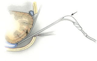 Prior to retracting the cerebellum posteriorly, it is necessary to release the cerebrospinal fluid (CSF) pressure by opening the cisterna magna. Premature retraction of the cerebellum, before decompressing the cistern, risks inducing massive cerebellar swelling. The CSF space is opened by gently elevating the cerebellum and then lacerating the arachnoidal wall of the cistern with a suction lancet or other sharp implement. This maneuver is depicted on this coronally oriented schematic diagram.
