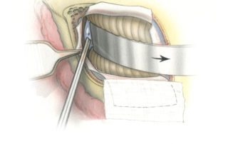 Opening of the cisterna magna during the retrosigmoid approach as seen in the surgical view.