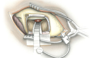 An Apfelbaum retractor is used as the base for a retractor arm which supports the malleable blade positioned on the lateral aspect of the cerebellum over a Telfa strip.