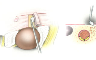 To expose the internal auditory canal (IAC) component of the tumor it is necessary to open the posterior osseous wall of the canal. In larger tumors, this aspect of the procedure is performed following debulking of the CPA component. When visually obscure, the orifice of the porus acusticus and thus the axis of the IAC can be located by palpation using a ball hook. To expose the bone overlying the IAC, dural flaps are elevated anteriorly and posteriorly. The purpose of preserving the dural flaps is to provide a purchase for suture closure of the defect at the end of the procedure. Incisions are made with a No. 11 blade and the dura is elevated with a stapes knife. The dura is dissected off of the endolymphatic sac, located inferolaterally. Prior to commencing with bone removal, Gelfoam (G) is placed in the posterior fossa to confine the spread of bone dust within the subarachnoid space. (10, vagus nerve; 9, glossopharyngeal nerve; ES, endolymphatic sac; 5, trigeminal nerve.)