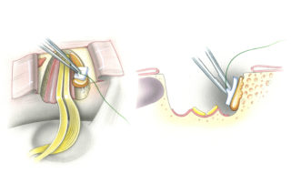 Following tumor resection the defect in the internal audiotory canal must be repaired to discourage CSF leak, a relatively frequent problem with this approach (approximately 15%). With use of a long blunt hook (3 mm), the cut bony surface is palpated to search for any open air cell tracts. Transected cells are occluded with bone wax, which is applied on a small cotton pledget.