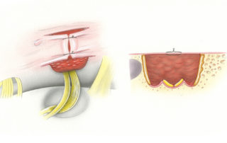 As a further discouragement to cerebrospinal fluid leak, the defect in the posterior petrous pyramid may be filled in by a free muscle plug harvest from the nuchal musculature. Currently we use abdominal fat to fill the defect as it is more easily distinguishable from recurrence followup magnetic resonance imaging scanning using fat saturation. The tissue may be retained in place by a stay suture anchored in the dural flaps, which never looks as neat as depicted in this drawing.