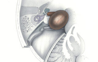 Axial schematic view of the retrosigmoid approach to the cerebellopontine angle and internal auditory canal (IAC) for a medium sized acoustic neuroma. Note that the craniotomy abuts the sigmoid sinus and that the posterior lip of the IAC has been drilled away to expose the intracanalicular component of the tumor. The degree of cerebellar retraction depicted is considerably more than that actually required.