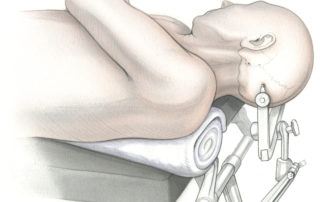 The patient is placed in a supine position with the shoulder elevated to augment suboccipital exposure. The head is secured in a Mayfield headholder.