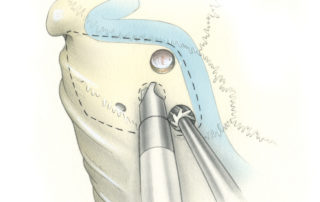 Craniotomy (dashed line) is initiated by placing four burr holes, the anterior two in proximity to the posterior margin of the sigmoid sinus.
