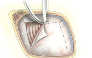 Dural incision (dashed line) is made approximately 5 mm from the edge of the craniotomy as depicted. This facilitates later suture closure of the dura. Relaxing incision are created which define small dural flaps which a tacked up with small sutures.