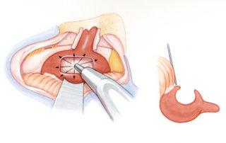 The tumor is debulked using a Cavitron Ultrasonic Surgical Aspirator® (CUSA). (A) Surgical view. (B) Schematic.