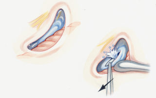 Once the dura has been opened, the cerebellum should be elevated (a Penfield No. 2 is used in this illustration) to expose the lateral aspect of the cisterna magna. Early opening of this cistern decompresses the posterior fossa and facilitates retraction of the cerebellum.