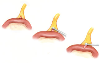 Frequently, strands of residual eighth nerve remain on the facial nerve during dissection. Being in the incorrect plane can give the mistaken impression that the facial nerve is adherent to the tumor. (A)The residual eighth nerves fibers can often be recognized as a triangular peak which grows broader as the dissection progresses medially. By liberating the apex of the triangle (B), the proper plane on the facial nerve can be re-established (C).