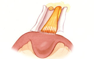Sometimes, a velum of residual superior vestibular nerve (SVN) overlies the facial nerve (7).