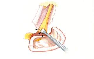 Typically, the most adherent portion of the tumor is addressed last with a combination of blunt and sharp dissection.