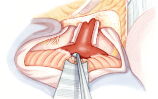 The lateral lobe of the cerebellum is dissected from the tumor. The tumor in this illustration is a medium sized acoustic neruoma, approximately 2 cm in diameter in the cerebellopontine angle.