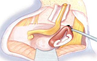Once liberated from the facial nerve, the remaining tumor is delivered. In this illustration, the last fragment abuts the proximal trigeminal nerve.