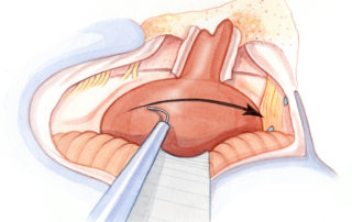 Sweeping of the posterior aspect of the tumor with the stimulating electrode to confirm that the facial nerve is not located on this surface.