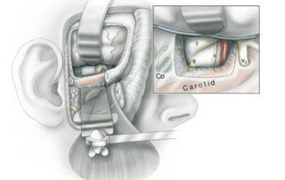 Preparation for the middle fossa-trans-petrous apex approach involves and extradural middle fossa craniotomy and downward displacement of the zygomatic arch. The lower retractor, positioned on the condylar fossa, is a Fisch-type infratemporal fossa retractor (modified pediatric rib spreader). Removal of the glenoid fossa is not always required, but it is important if dissection is to be performed beneath the intrapetrous carotid artery. Considerable stretch maybe be placed on the forehead branch of the facial nerve, and it occasionally becomes neuropraxic. The upper retractor on the temporal lobe is a conventional malleable blade. Bone of the anterior face of the petrous pyramid is drilled away after elevating the dura. The region of bone is widely known as Kawase’s triangle, although it is actually rhomboidal in shape (see previous image). The greater superficial petrosal nerve, which traverses this surface, usually needs to be sacrificed. It is best to divide the nerve sharply, anterior to its takeoff from the geniculate ganglion, rather than to avulse it with a drill and risk inducing an intrageniculate hematoma. Bone is removed between the inner ear and Meckel’s cave containing the trigeminal ganglion. The inferior limit of exposure is the horizontal segment of the petrous carotid artery. If additional exposure is needed, the internal auditory canal can be skeletonized in a similar manner to that employed in the extended middle fossa approach to the cerebellopontine angle (see secion 2.1 in Chapter 2). Posterior fossa exposure (inset) includes the ventral and lateral surfaces of the upper pons. The basilar artery as well as the fifth, sixth, and eighth cranial nerves can be visualized. Exposure is limited inferiorly due to the shelf created by the carotid artery. Some have advocated repositioning the carotid artery out of its bony channel in selected cases, but in my opinion, this is seldom necessary or wise. (Co, cochlea; 8, audiovestibular nerve; 5, posterior fossa root of the trigeminal nerve; 6, abducens nerve; B, basilar artery; V3, third division of the trigeminal nerve.)