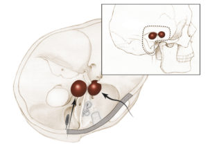 Bilobed tumors of Meckel’s cave, which possess substantial components in both the middle and posterior fossa, require a combined approach. (See section 6.1 in Chapter 6). The surgical view is indicated by an arrow.