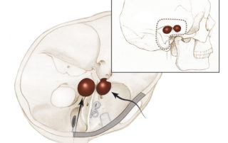Bilobed tumors of Meckel’s cave, which possess substantial components in both the middle and posterior fossa, require a combined approach. (See section 6.1 in Chapter 6). The surgical view is indicated by an arrow.