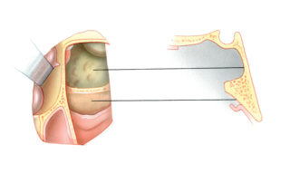 After widely opening the sphenoid sinus and removing the intersinus septum, the floor of the sella turcica becomes visible. On the superolateral wall of the sinus the carotid artery and optic nerve may become visible. Below the floor of the sphenoid the mucoperiosteal layer overlying the clivus is reflected inferiorly. (CA, carotid artery; ON,optic nerve; ST, sella turcica.)