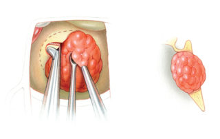 Resection of a clival tumor (e.g. chordoma) is carried out with a blunt dissector and a suction. Bony overhangs are removed with a rongeur or drill.