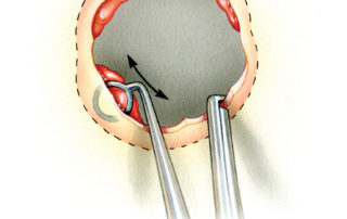 An angled curette may prove helpful is removing scraps of tumor from difficult to access regions.