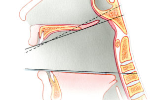 A schematic view in the saggital plane of the transoral approach to the clivus and craniovertebral junction. The solid lines depict the usual extent of surgical exposure. The dashed line illustrates the additional access to the mid-clivus provided by resection of a portion of the hard palate.