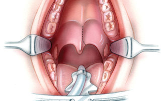 A self-retaining retractor (e.g., Dingman) maintains exposure during the procedure. The incision splits the midline of the soft palate (dashed line).