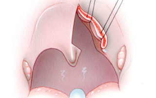 The leaves of the soft palate are retracted with stay sutures.