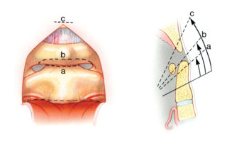 When exposing the odontoid process, the angle of visualization is looking upward. The lower portion of the odontoid can be reached without disturbing the anterior arch of the atlas (A). In many cases, excision of only the lower portion of the arch of C1 (B) is sufficient to provide access to the entire odontoid. When wider exposure is required, the entire width of the arch of the atlas can be removed (C).