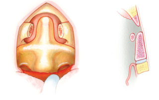 Removal of the anterior arch of C1 exposes the odontoid process.