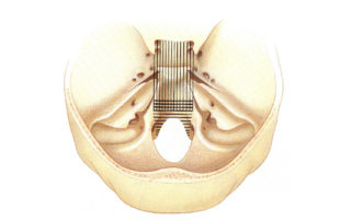 View of the cranial base as seen form above illustrating the exposure which can be obtained by the transsphenoethmoid approach (vertical lines) and transoral approach (horizontal lines).