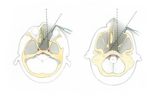 Axial schematic views of the exposure of midline structures which may be obtained via the transsphenoethmoidal approach. At the mid-orbital level (higher) visualization is provided of the entire sphenoid sinus including the sella turcica and the back wall of the sinus. At the level of the maxillary sinus (lower), the mid-and lower clivus is accessible.