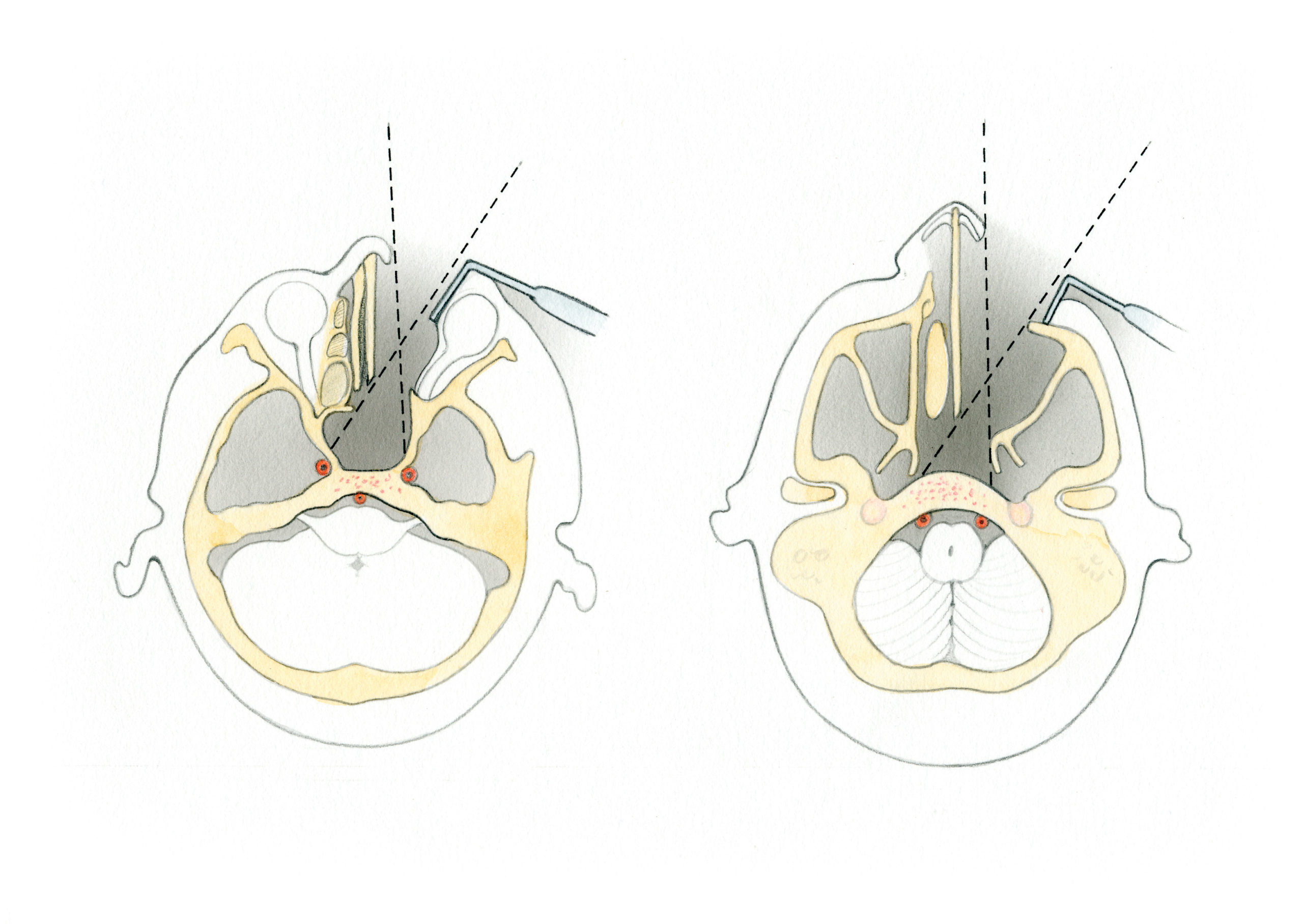 Anterior Approaches To Clivus Skull Base Surgery Atlas 1649