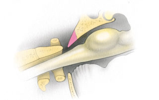 The lower third of the clivus cannot be directly visualized via a combined transtemporal - middle fossa approach in most cases. However, much of the tumor in this region can be delivered by blindly sweeping the bony cavity created by the tumor. Far inferior extensions and those which extend laterally at the craniovertebral junction require either simultaneous performance of a far lateral approach to the foramen magnum (see Chapter 9 or second stage for transoral resection of the tumor remnant).