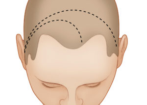 Figure 12-1 Position and incision (dashed line). The patient is placed supine and the ipsilateral shoulder is elevated to permit turning of the head into the lateral position. A Mayfield headholder is placed and the head is rotated 20 degrees ipsilaterally and tilted down 20 degrees to bring the pterion uppermost. The incision is designed to expose the temporal muscle while preserving the posterior branch of the superficial temporal artery and the temporal and zygomatic branches of the facial nerve. It begins in the pretragal crease just below the root of the zygoma and passes superiorly across the superior temporal line behind the coronal suture before arcing anteriorly to the midline hairline. A receding hairline may require a full bicoronal incision.