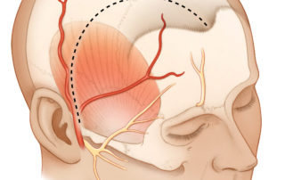Figure 12-2 Soft tissue dissection. The incision (dashed line) is carried through skin, galea, and pericranium but not temporal fascia. The resulting scalp flap is elevated anteriorly, leaving the temporal fascia intact except far anteriorly, just posterior to the lateral orbital rim. Here, superficial temporal fascia is incised to expose a fat pad, which lies superficial to deeper temporal fascia and contains distal temporal and zygomatic branches of the facial nerve. The fat pad and nerves are elevated along with the scalp and pericranium over the lateral orbital rim. This is continued superiorly to expose the superior orbital rim (where the supraorbital branch of the frontal nerve may need to be freed from its foramen) and inferiorly to expose the zygomatic arch back to its root. The temporal fascia is incised at its superior and posterior margins, leaving a cuff to which to sew at closing. The muscle is then mobilized from its fossa with dissection from inferior to superior along its deep surface.