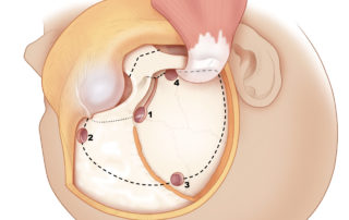 Figure 12-3 Craniotomy with orbitozygomatic osteotomy. Frontotemporal craniotomy and orbital osteotomy are performed using four burr holes: (1) external orbital angle, entering both the anterior cranial fossa and the orbit; (2) anterior inferior lateral frontal; (3) superior posterior temporal; and (4) anterior inferior temporal. The last three are connected with a craniotome, whose cut is extended anteriorly into the supraorbital notch.
