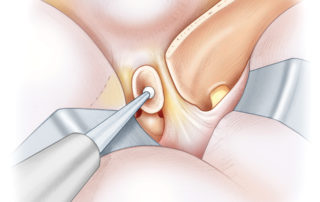 Figure 12-9 Removal of the anterior clinoid process and optic strut. A fine diamond drill under continuous irrigation is used to remove the roof of the optic canal and the anterior clinoid process. This exposes the dura of the superior orbital fissure and reveals the optic strut forming the inferior lateral wall of the intracranial end of the optic canal. This, too, can be drilled away to widen access to the paraclinoidal internal carotid artery.