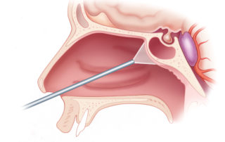 Endoscopic endonasal approach to the central skull base. The divergent light of an endoscope placed in one nostril illuminates a broad area of the anterior and central skull base. Straight and angled endoscopes permit access to the frontal sinus, cribriform plate, ethmoid roof, sphenoid sinus, planum sphenoidale, sella, pituitary gland, suprasellar region, cavernous sinuses, dorsum sella, and midclival regions. This facilitates repair of encephaloceles and removal of tumors such as esthesioneuroblastomas, meningiomas, pituitary tumors, and clival chordomas.