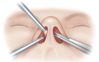 Binarial endoscopic technique. Use of both nares permits bimanual dissection. For lesions accessed through the sphenoid sinus, the endoscope is best held by one surgeon superiorly in one nostril. This leaves ample room for the second surgeon to use two dissecting instruments, one in each nostril.
