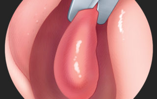 Middle turbinate removal. Sufficient access to the sphenoid sinus can usually be achieved by lateral displacement of the middle turbinate and superior turbinate on each side. The turbinates should be preserved whenever possible. However, a hypertrophic middle turbinate on the side to which the septum is deviated (right shown) may need to be resected. After its mucosa is injected with epinephrine and lidocaine to reduce bleeding, the turbinate is divided near its root and removed.