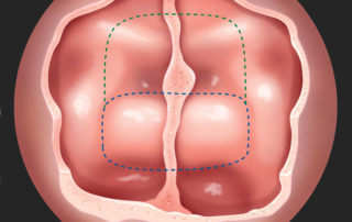Sellar face. This wide sphenoidotomy provides sufficient space for manipulating the endoscope and two dissecting instruments through wide arcs without their impeding one another. This permits removal of any septations within the sphenoid sinus and visualization of its roof (planum sphenoidale), posterior wall (tuberculum sella, sellar face, and middle clivus), and each lateral wall (covering the intracavernous internal carotid artery and intracanalicular optic nerve). Bone removal begins over the anterior sella dura (lower dashed rectangle, blue); this can be extended laterally (over each cavernous sinus), superiorly (removing the tuberculum sella, bone over the medial optic-carotid recess, optic canals, and planum sphenoidale (upper dashed rectangle, green), and inferiorly (across the sella floor and down the midclivus).