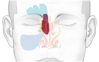 Esthesioneuroblastoma: anterior posterior view. A similar strategy permits removal of tumors of the anterior skull base such as esthesioneuroblastoma. This large tumor eroding through the cribriform plate and extending into the anterior cranial fossa and frontal sinus can be resected by an endoscope and instruments directed anterior and superior.
