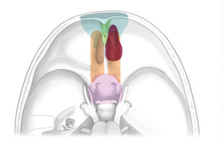 Esthesioneuroblastoma: axial view.