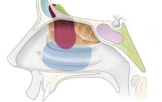 Esthesioneuroblastoma: sagittal view.