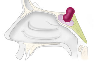 Macroadenoma: sagittal view.